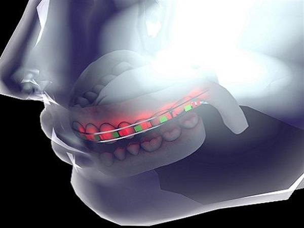 saudi-researchers-propose-3d-printed-braces-leds-batteries-faster-teeth-alignment-1.jpg