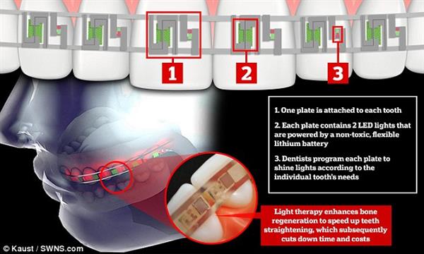 saudi-researchers-propose-3d-printed-braces-leds-batteries-faster-teeth-alignment-2.jpg